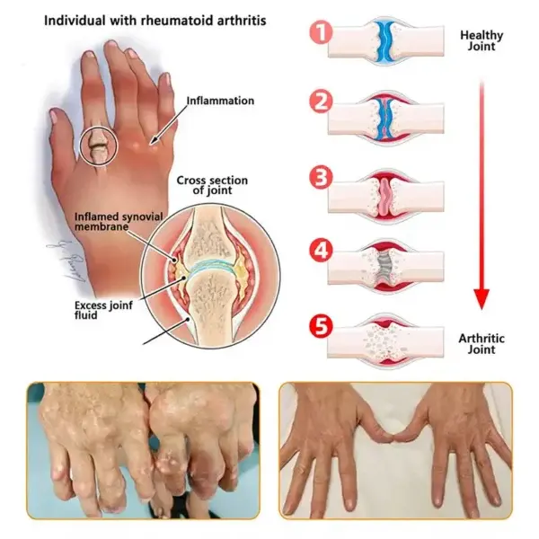 Bee Venom Pain-Relief Bone Healing Spray