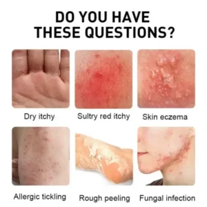 Psoriasis Cure Cream