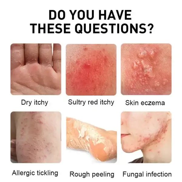 Psoriasis Cure Cream