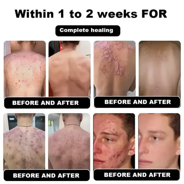 Psoriasis Cure Cream