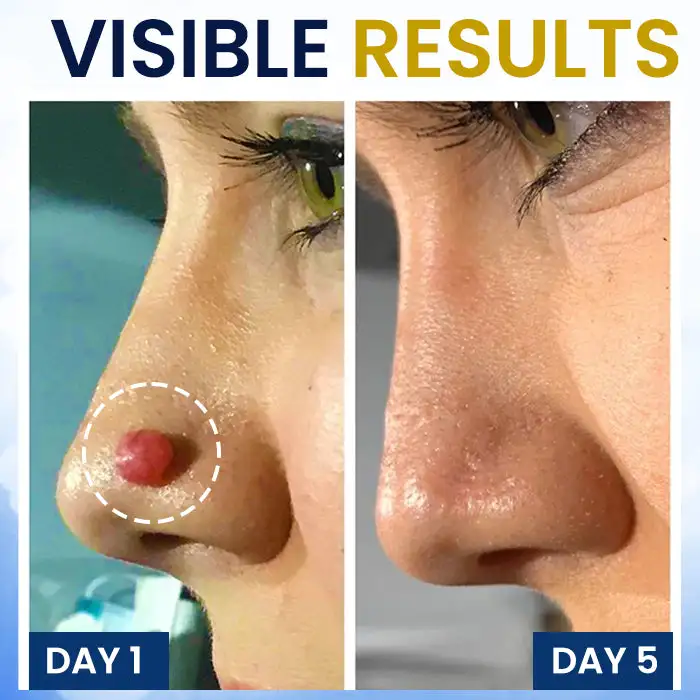 Skin Tag Cryo Treatment Spray - Image 3