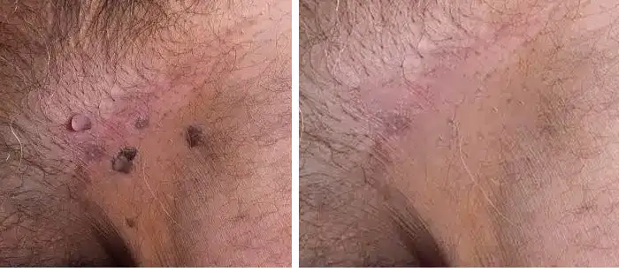 |Genital Warts Remover Cream for Men - Image 25