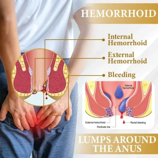 Apis Venom Hemorrhoid Cooling Spray - Image 6