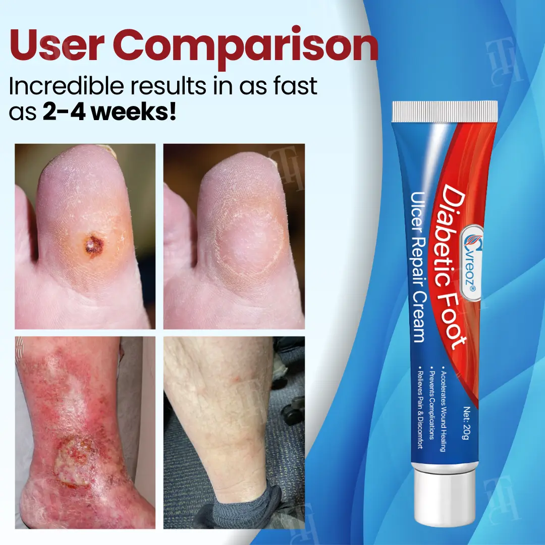 Diabetic Foot Ulcer Repair Cream - Image 2