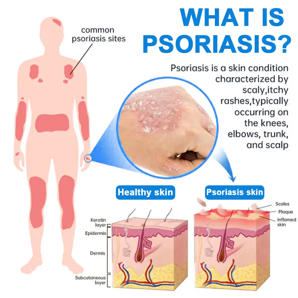 Magnesium Herbal Psoriasis Spray FDA Approved - Image 5