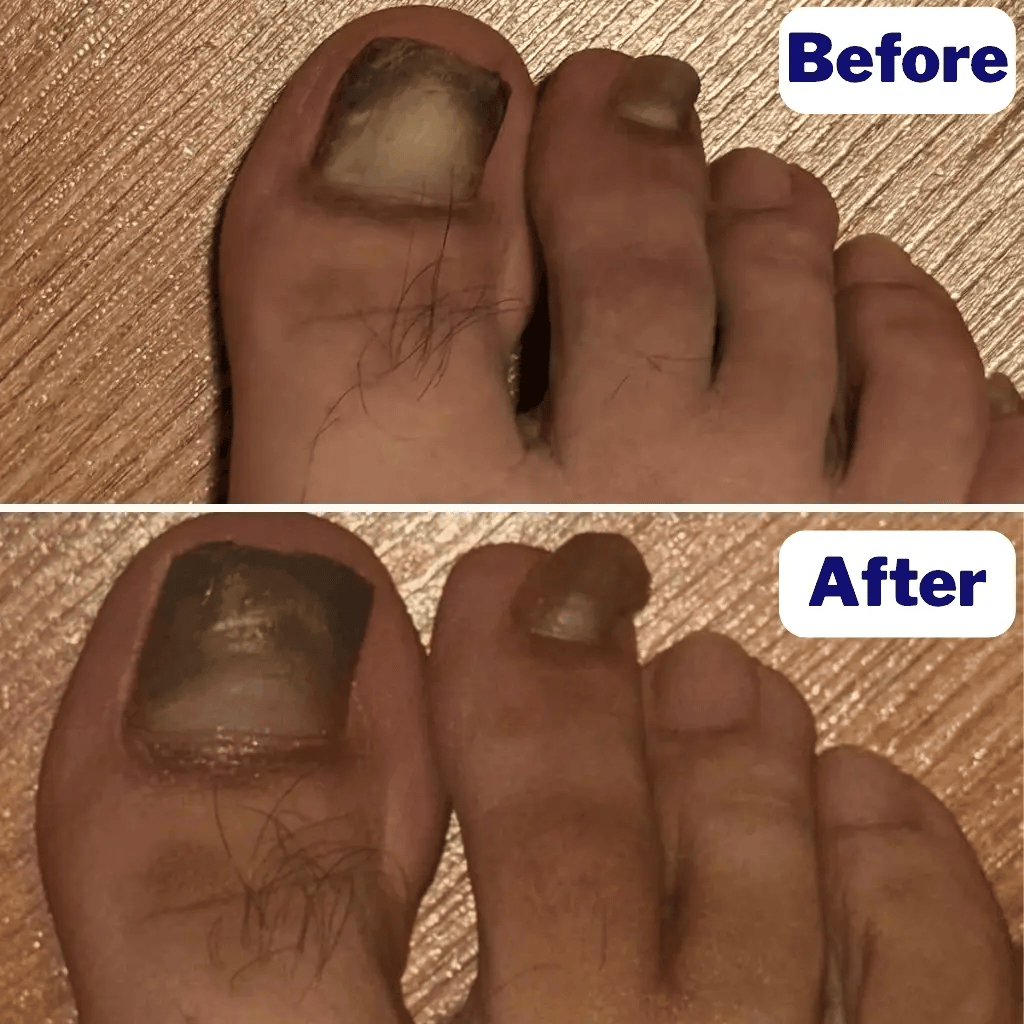 Nail Fungal Patches Pro+ - Image 4