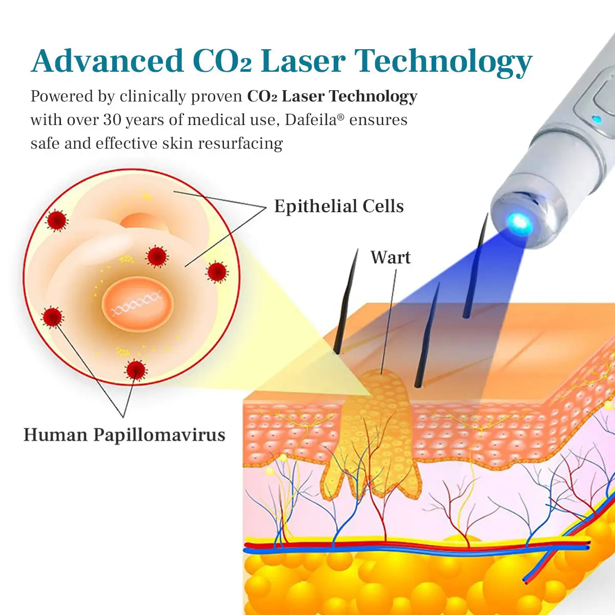 LumeSkin Mole and Wart Removal Laser Pen - Image 5