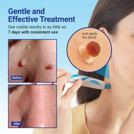 ClearDerm At-home Skin Tag Removal Pen - Image 3