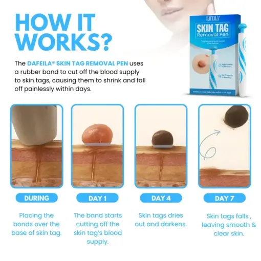 Skin Tag Removal Pen - Image 4