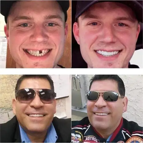 Adjustable Adhesive Dentures - Image 5