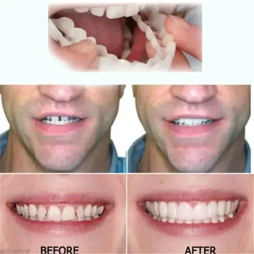 Adjustable Adhesive Dentures - Image 7