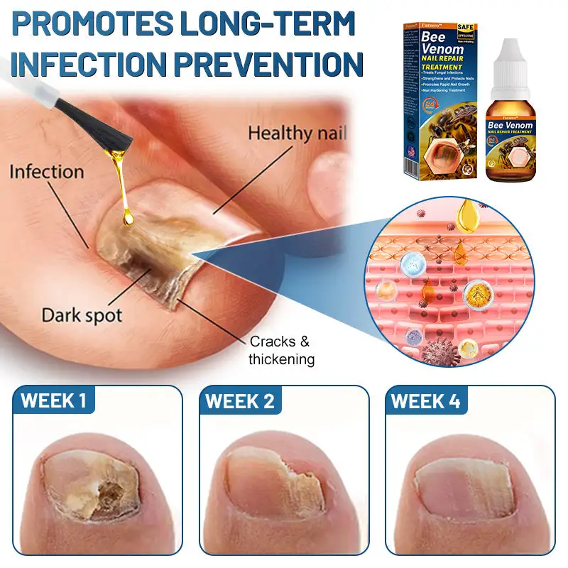 Bee Venom Nail Repair Treatment - Image 5