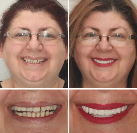 Advanced Customized Full Denture Set - Image 7