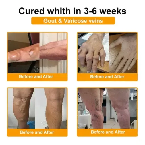 Bee Venom Pain-Relief Bone Healing Spray - Image 5