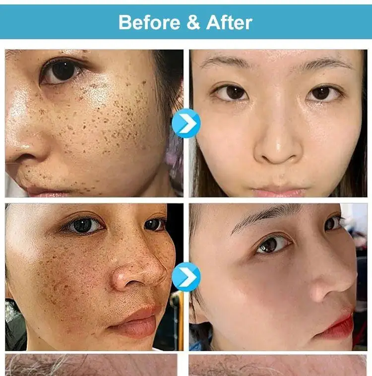 Concentrated potent skin tag removal cream - Image 2