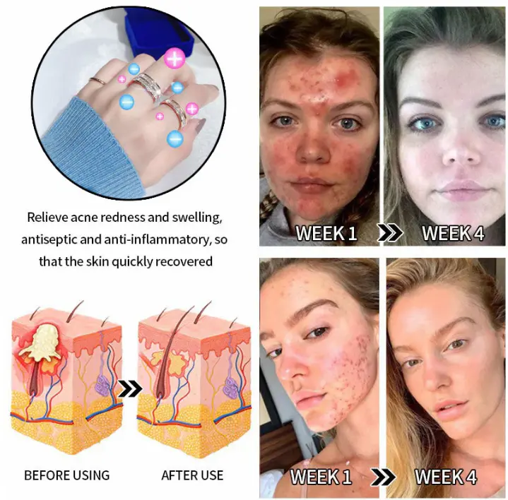 DIYSTAR Lymphatic Magnetic Therapy Diamond Ring - Image 8