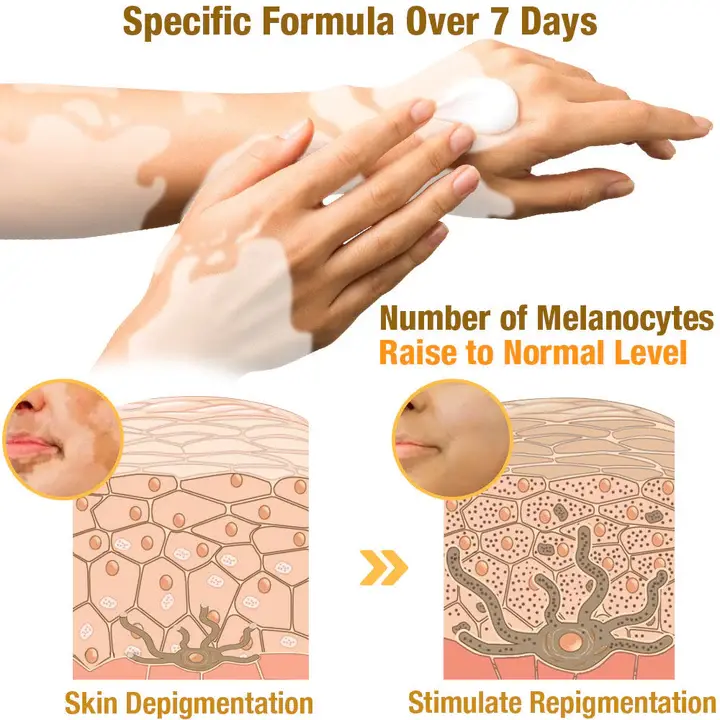 BeeVenom Vitiligo Treatment Cream - Image 3