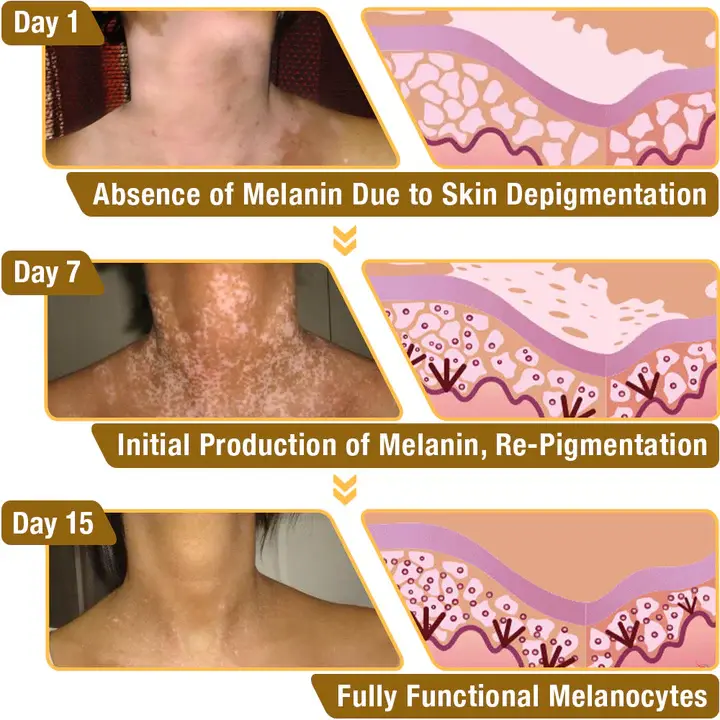 BeeVenom Vitiligo Treatment Cream - Image 4