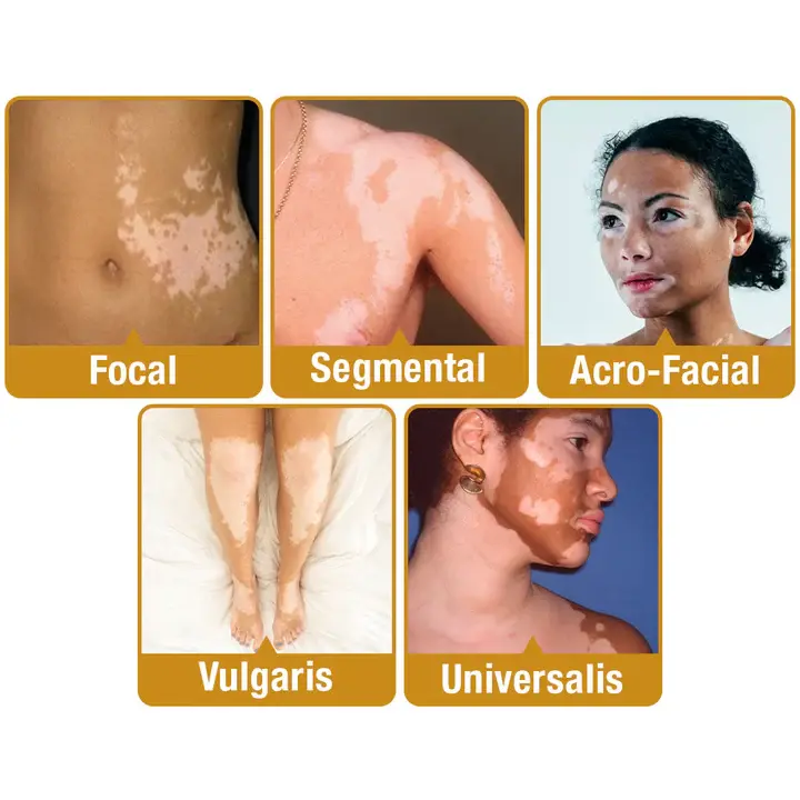 BeeVenom Vitiligo Treatment Cream - Image 7
