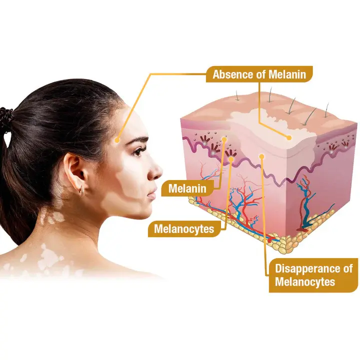 BeeVenom Vitiligo Treatment Cream - Image 8