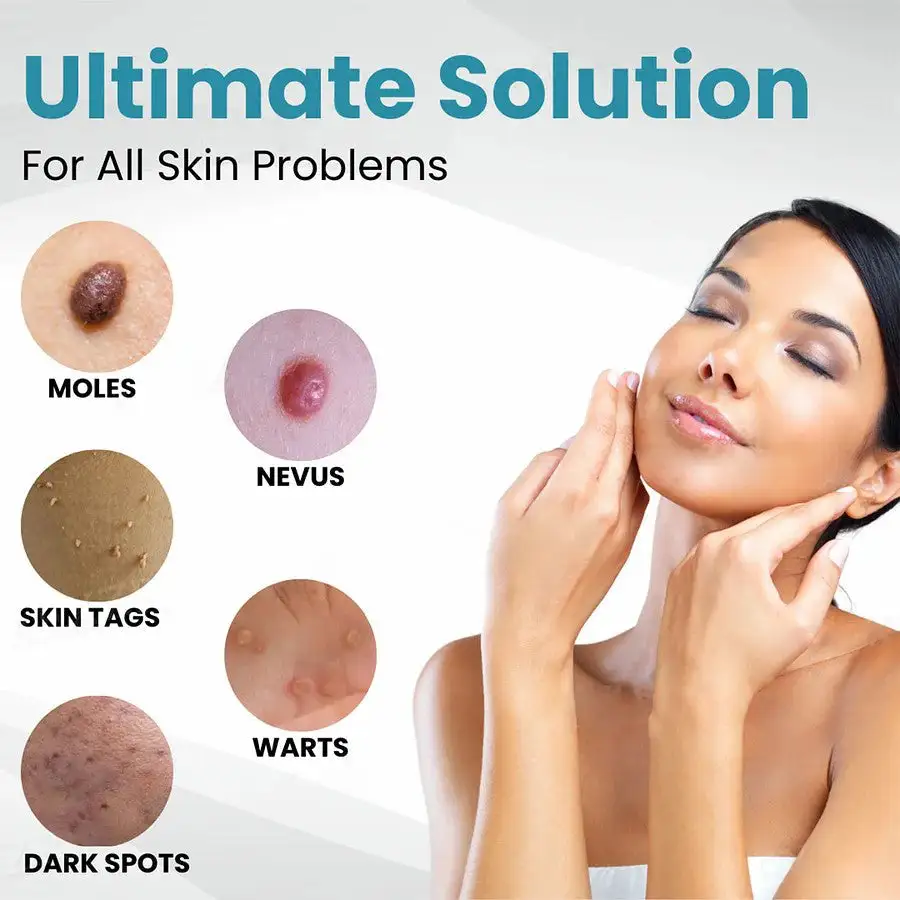 Non-Invasive Mole and Wart Removal Laser Pen - Image 8