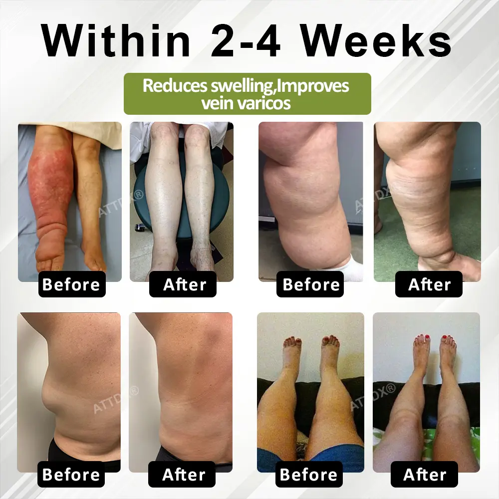 VeinoRoll Therapy Edema Comfort Cream - Image 3