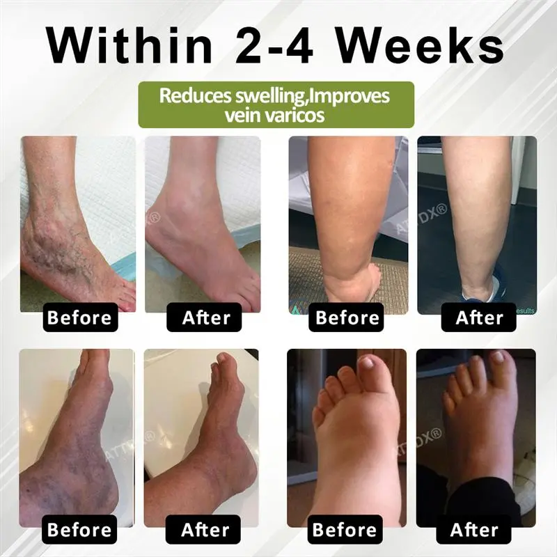 VeinoRoll Therapy Edema Comfort Cream - Image 4