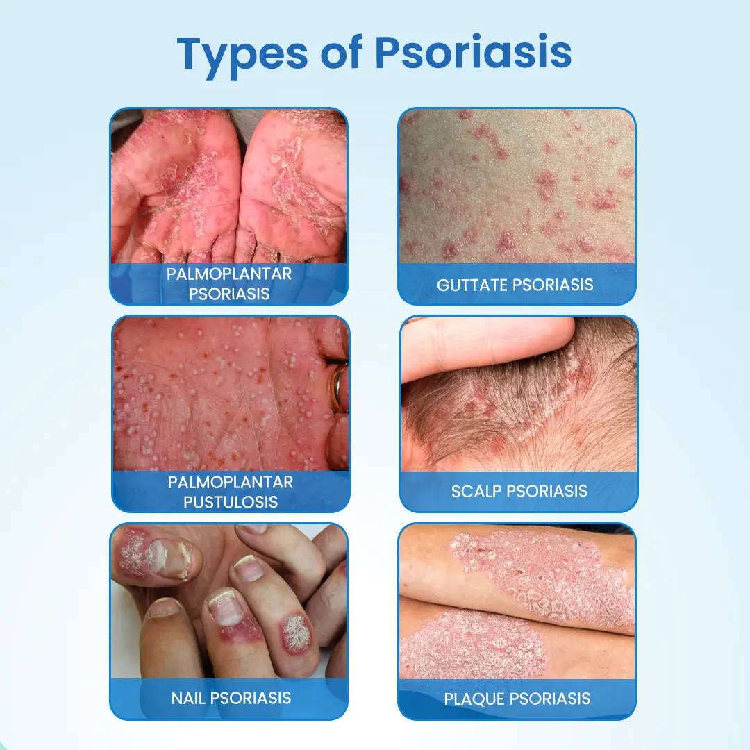 MagnesiumHerb Psoriasis Relief Cream - Image 8