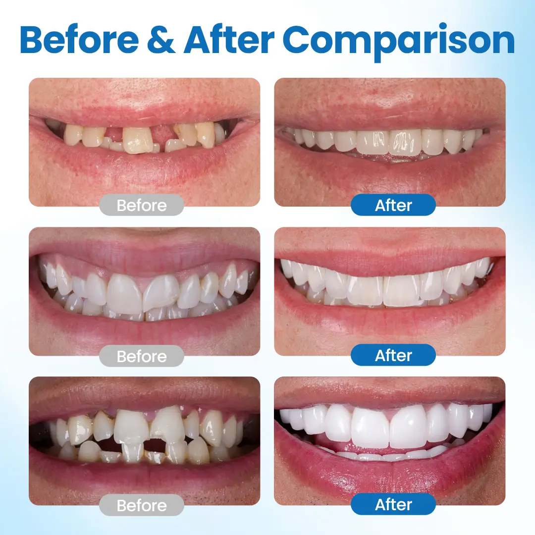SmileMend Tooth Repair Filling Kit - Image 2