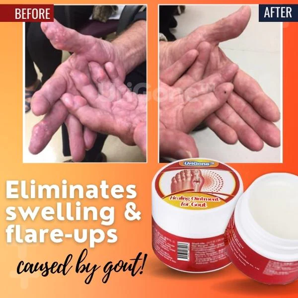 Healing Ointment for Gout - Image 4