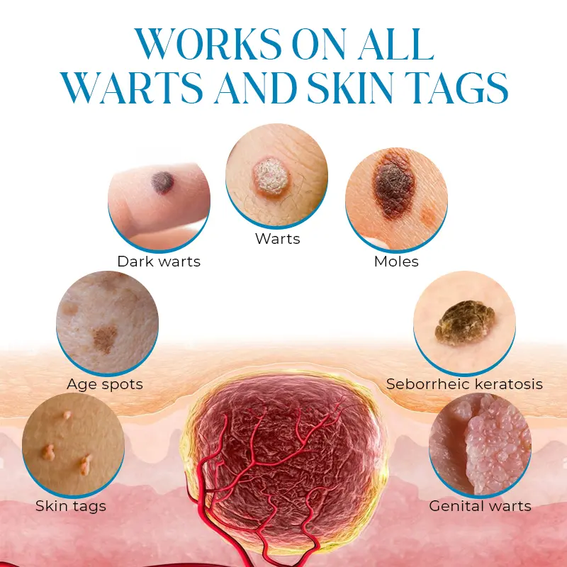 PapiClear Skin Tag & Wart Cream - Image 6