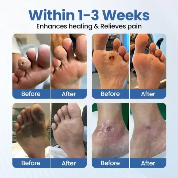 VenHeal Bee Venom Diabetic Wound Spray - Image 2