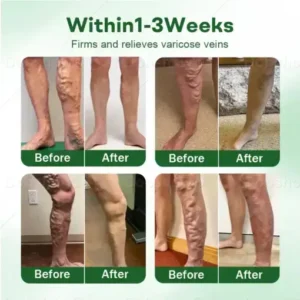 Alternative view of VeinLock Microneedle Patch