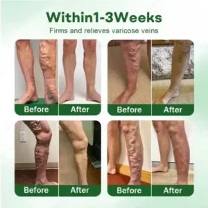 Alternative view of VeinLock Microneedle Patch