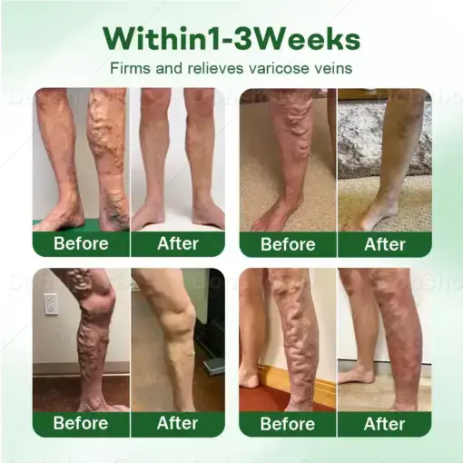 VeinLock Microneedle Patch - Image 2