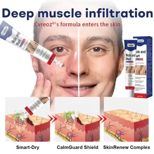 Mole and Wart Removal Cream - Image 5