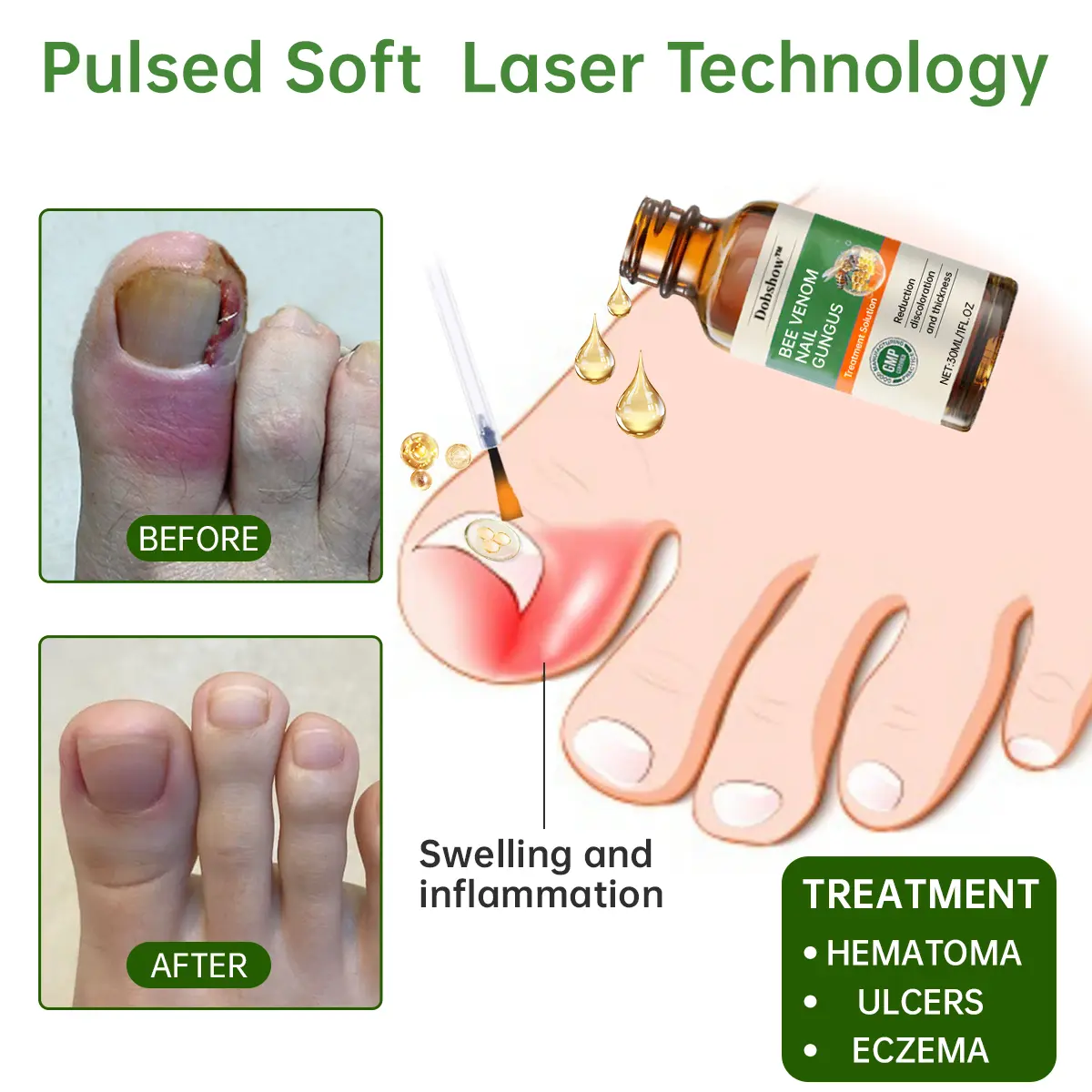 Bee Venom Nail Fungus Treatment Liquid - Image 7