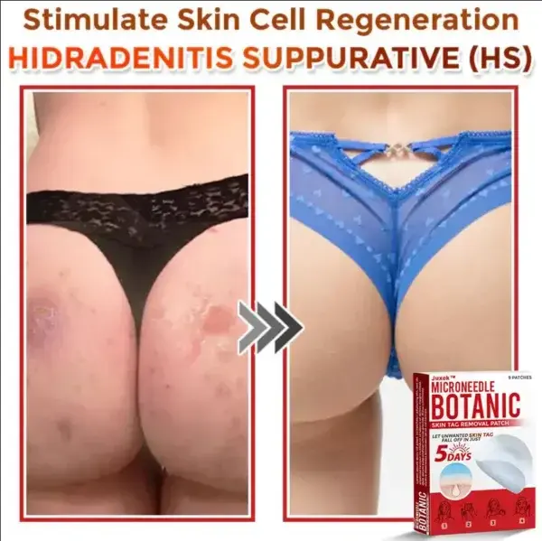 Removal Patch: Gentle Microneedle Patches for Skin Tag & Mole Removal - Image 10