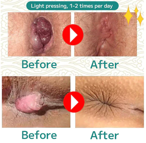 Natural Herbal Strength Hemorrhoid Capsules - Image 4