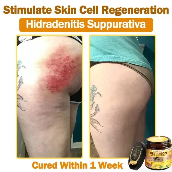 𝐁𝐞𝐞 Poison 𝐀𝐥𝐥-𝐢𝐧-𝐎𝐧𝐞 𝐂𝐫𝐞𝐚𝐦 - Image 11