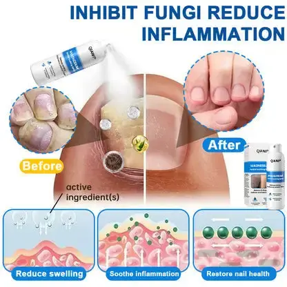 QIAWI Magnesium Herbal Psoriasis Spray - Image 4