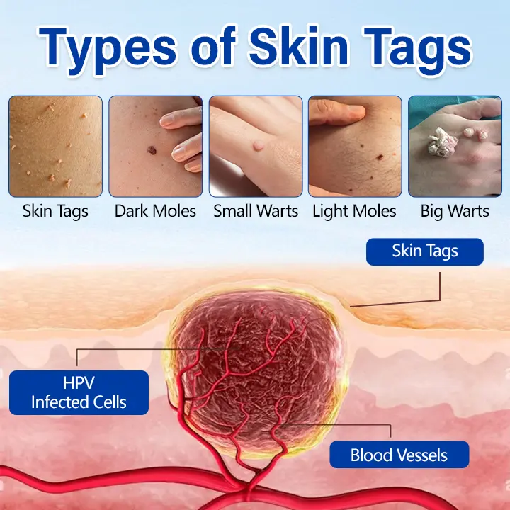 WartClear Herbal Ointment - Image 3