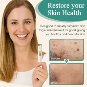 Alternative view of LumeSkin Mole and Wart Instant Removal Laser Pen ACE 4