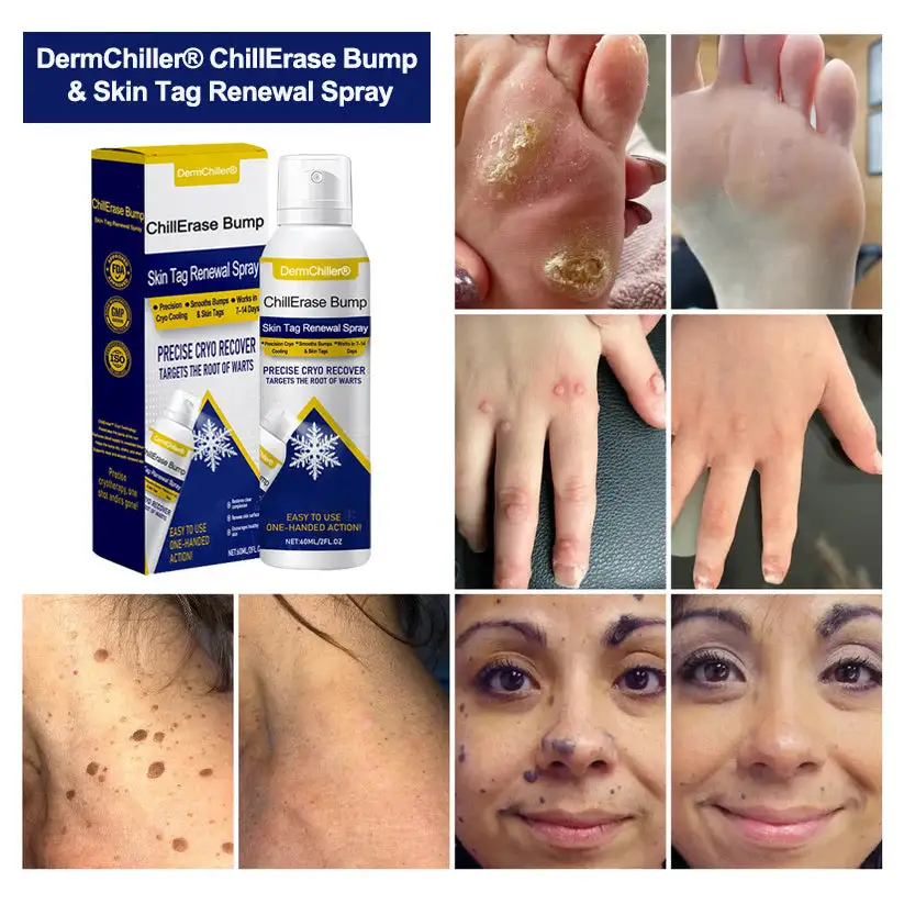 ChillErase Bump & Skin Tag Renewal Spray - Image 2