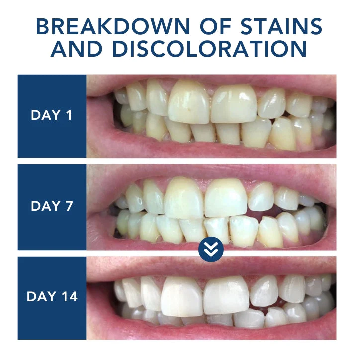 ProTeeth Aufhellung Bausatz - Image 5