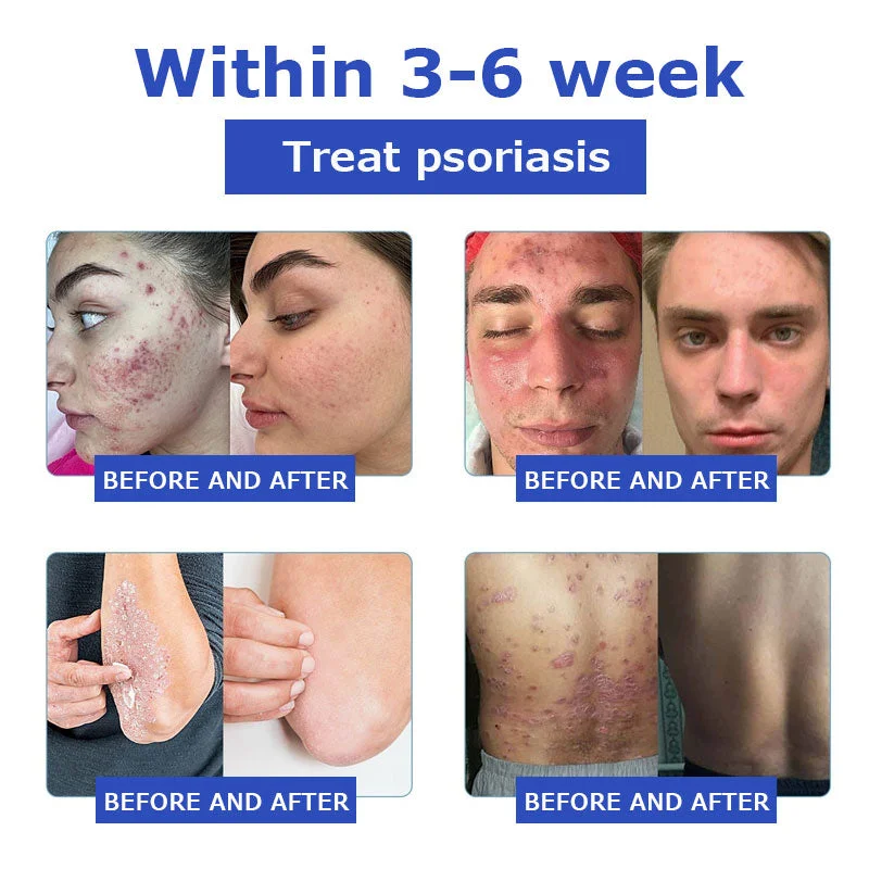 OceanCure Bee Venom Psoriasis & Wart Healing Cream - Image 7