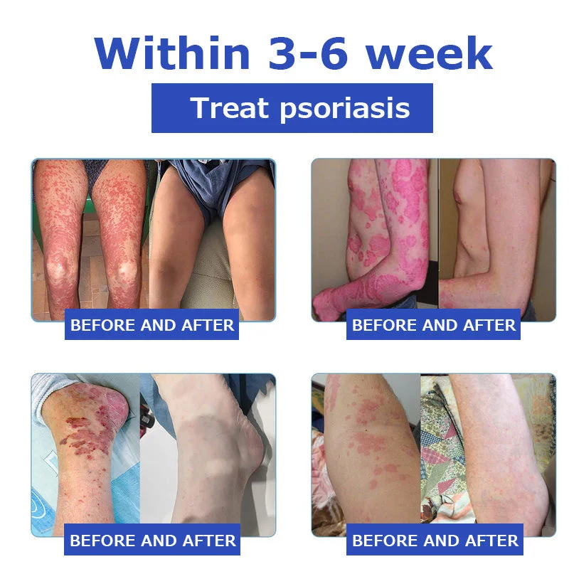 OceanCure Bee Venom Psoriasis & Wart Healing Cream - Image 8