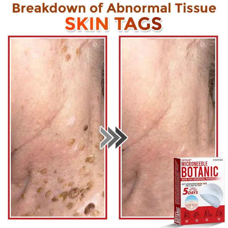 MicroNeedle Botanic Skin Tag Removal Patch - Image 6