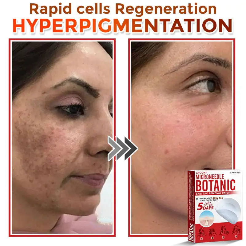 MicroNeedle Botanic Skin Tag Removal Patch - Image 7