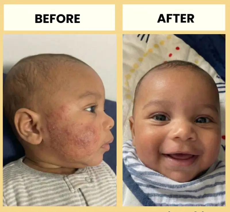 Honey Eczema Cream - Image 8